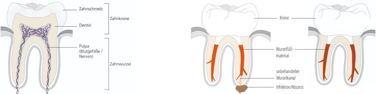 Aufbau eines Zahns zur Darstellung einer Wurzelbehandlung
